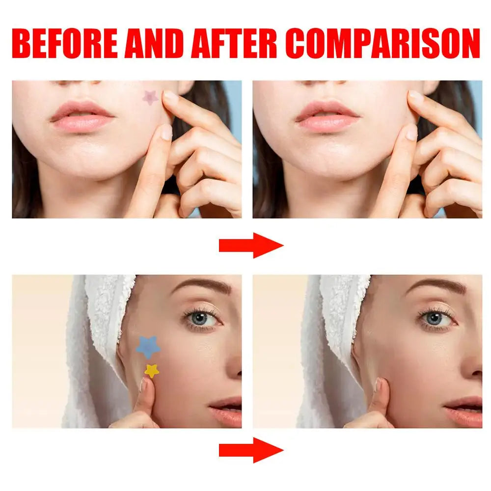 200pcs Star Pimple Patch Acne Invisible Acne Removal Stickers Originality Concealer Face Spot Beauty Skin Care Makeup Tools